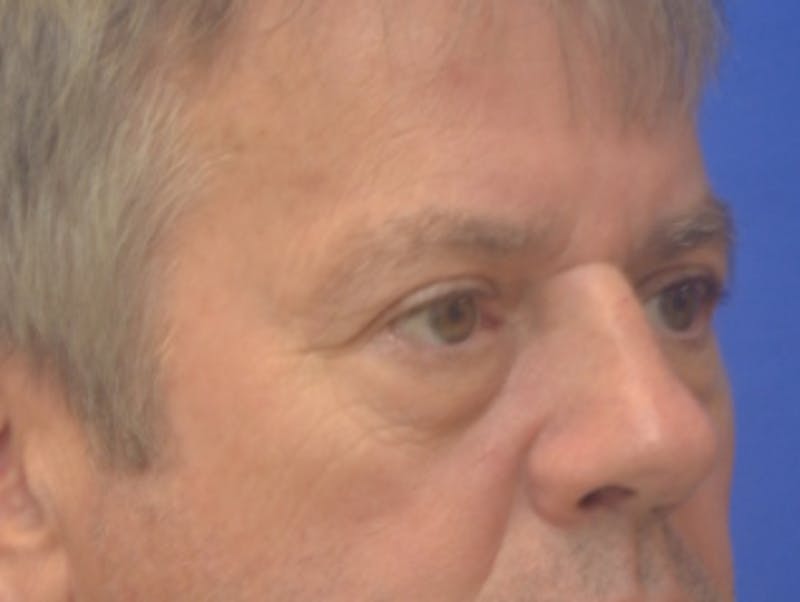 Blepharoplasty Before & After Gallery - Patient 184382 - Image 7