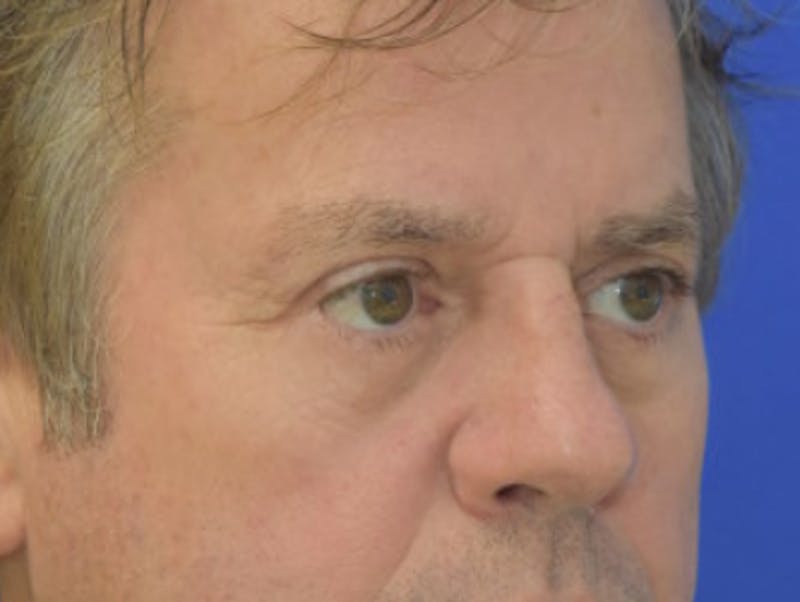 Blepharoplasty Before & After Gallery - Patient 184382 - Image 8