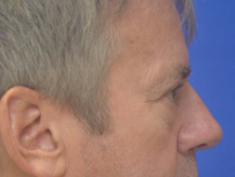 Blepharoplasty Before & After Gallery - Patient 184382 - Image 9