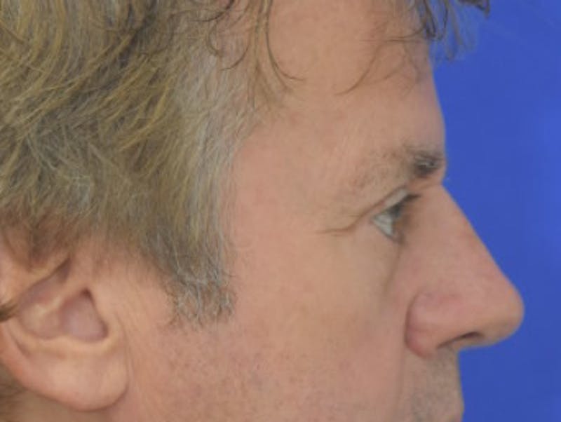 Blepharoplasty Before & After Gallery - Patient 184382 - Image 10