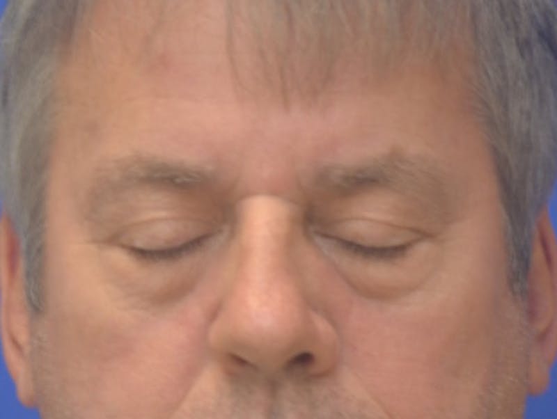 Blepharoplasty Before & After Gallery - Patient 184382 - Image 11