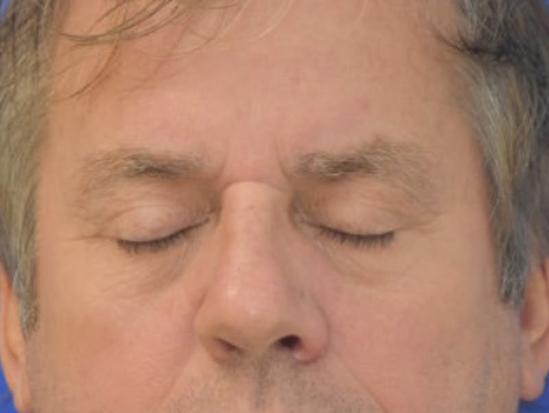 Blepharoplasty Before & After Gallery - Patient 184382 - Image 12