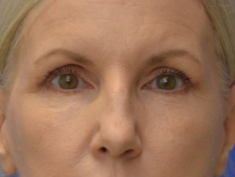 Blepharoplasty Before & After Gallery - Patient 171269 - Image 1