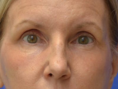 Blepharoplasty Before & After Gallery - Patient 171269 - Image 2