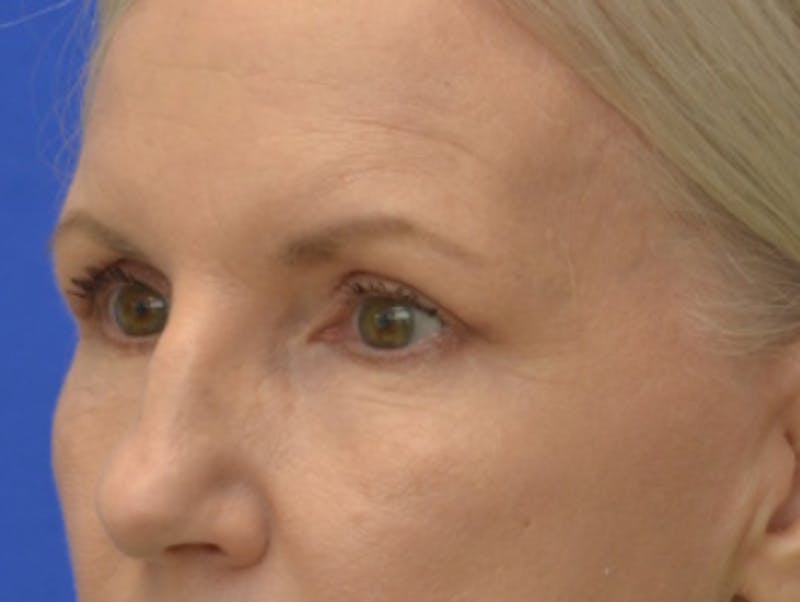 Blepharoplasty Before & After Gallery - Patient 171269 - Image 3