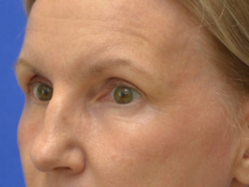 Blepharoplasty Before & After Gallery - Patient 171269 - Image 4