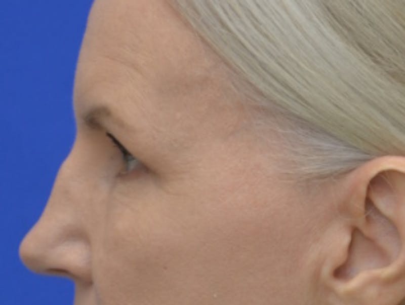 Blepharoplasty Before & After Gallery - Patient 171269 - Image 5