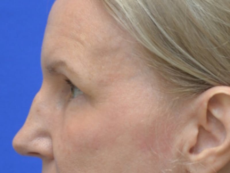 Blepharoplasty Before & After Gallery - Patient 171269 - Image 6