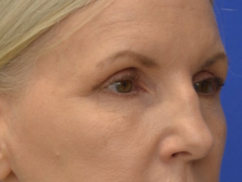 Blepharoplasty Before & After Gallery - Patient 171269 - Image 7