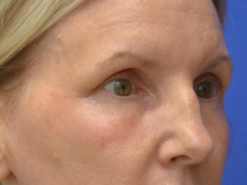Blepharoplasty Before & After Gallery - Patient 171269 - Image 8