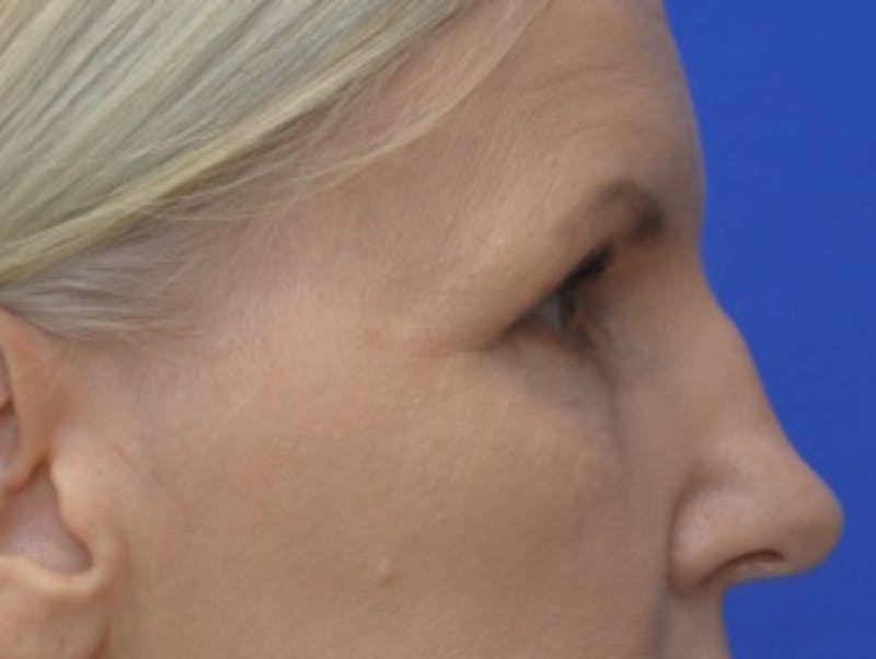 Blepharoplasty Before & After Gallery - Patient 171269 - Image 9