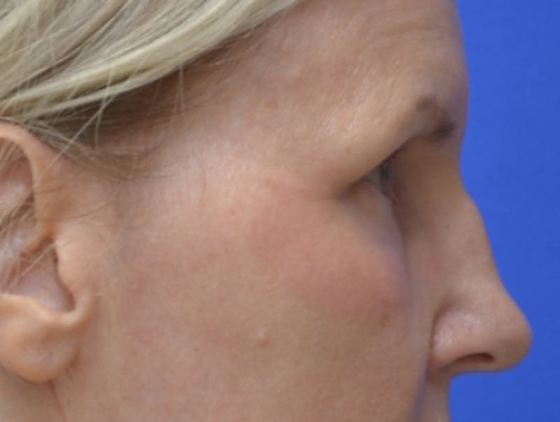 Blepharoplasty Before & After Gallery - Patient 171269 - Image 10