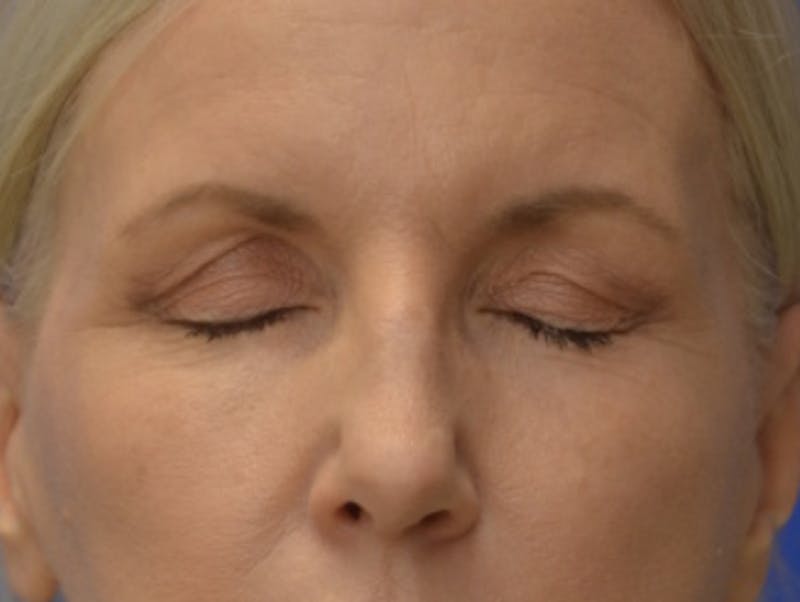 Blepharoplasty Before & After Gallery - Patient 171269 - Image 11