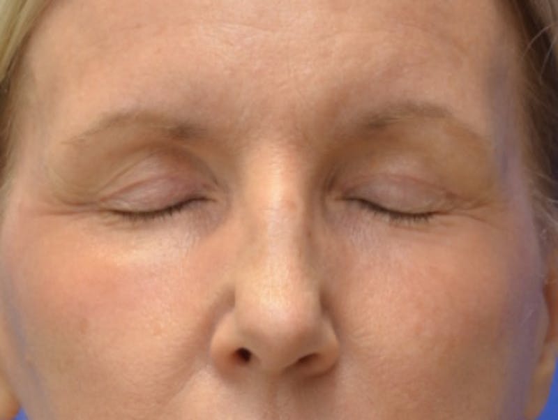 Blepharoplasty Before & After Gallery - Patient 171269 - Image 12