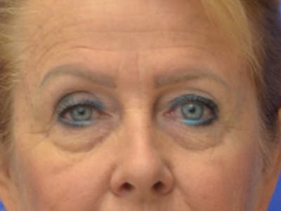 Blepharoplasty Before & After Gallery - Patient 182159 - Image 1