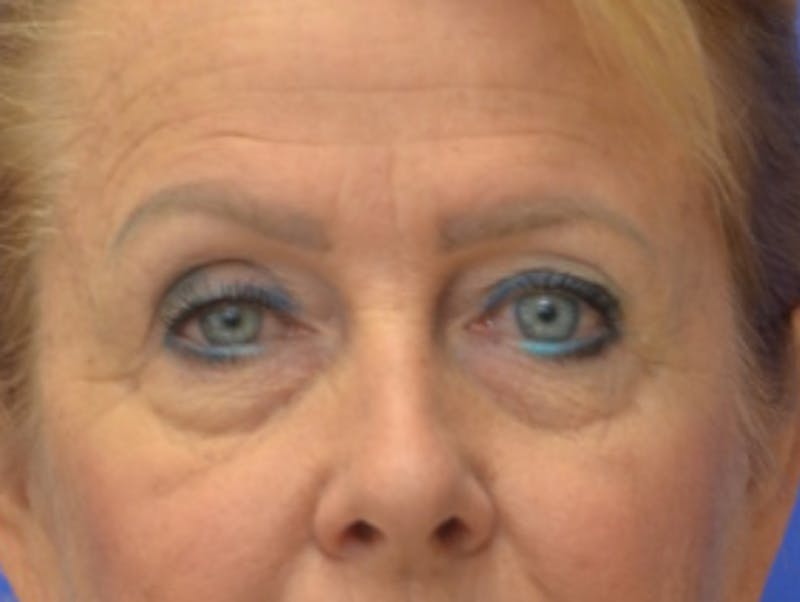 Blepharoplasty Before & After Gallery - Patient 182159 - Image 1