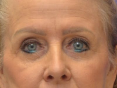 Blepharoplasty Before & After Gallery - Patient 182159 - Image 2