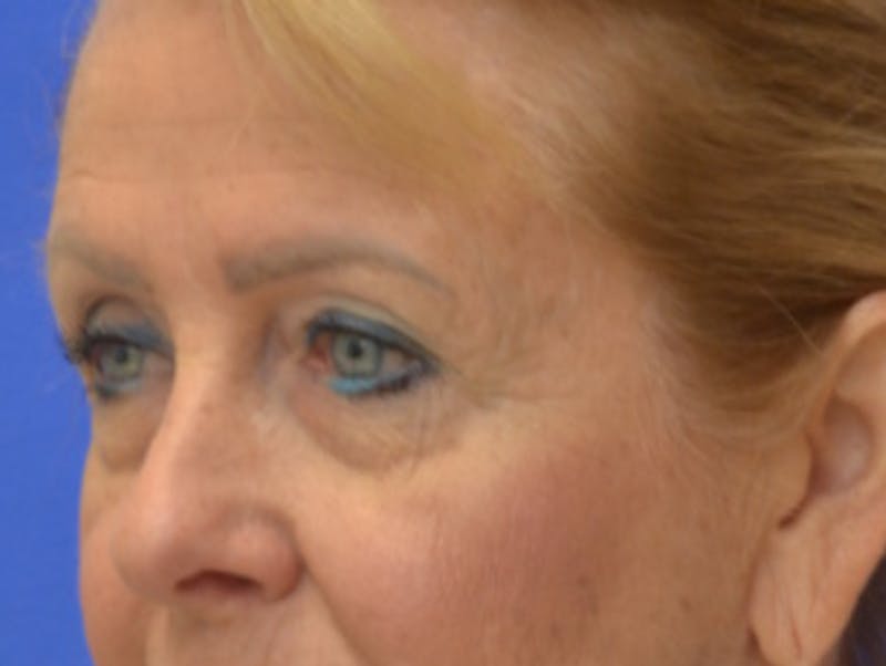 Blepharoplasty Before & After Gallery - Patient 182159 - Image 3