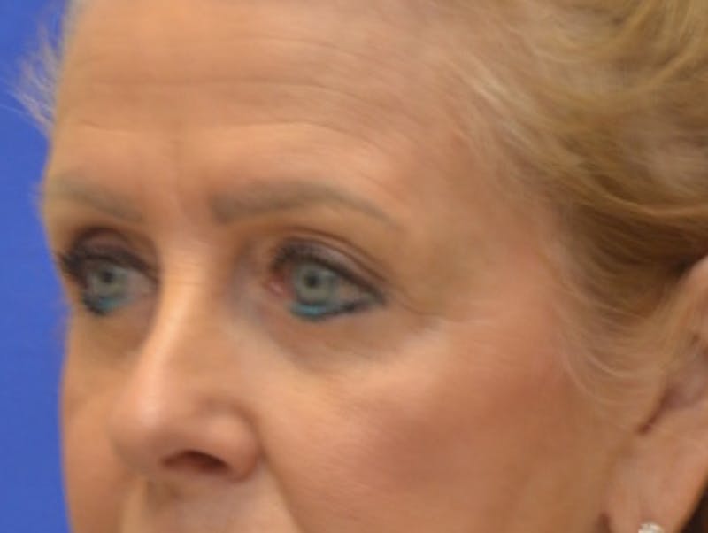 Blepharoplasty Before & After Gallery - Patient 182159 - Image 4
