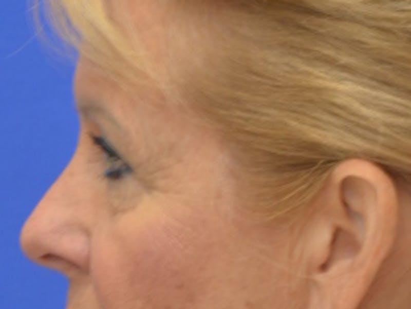 Blepharoplasty Before & After Gallery - Patient 182159 - Image 5