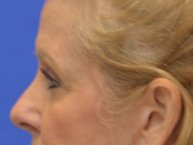Blepharoplasty Before & After Gallery - Patient 182159 - Image 6