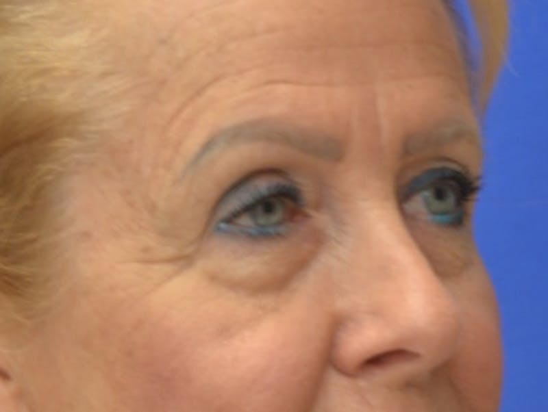 Blepharoplasty Before & After Gallery - Patient 182159 - Image 7