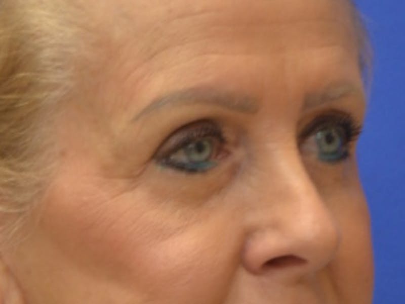 Blepharoplasty Before & After Gallery - Patient 182159 - Image 8