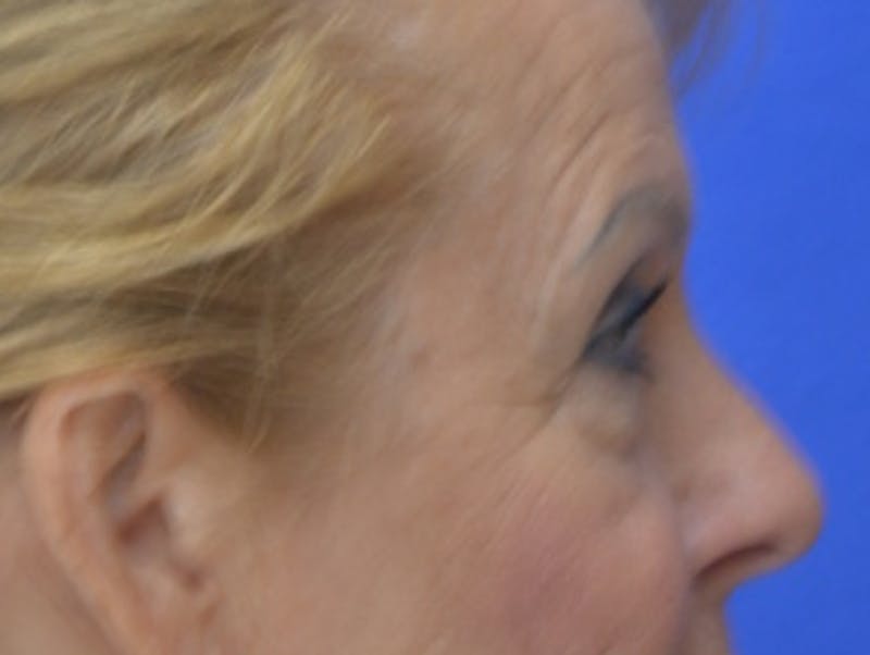 Blepharoplasty Before & After Gallery - Patient 182159 - Image 9