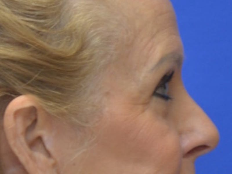Blepharoplasty Before & After Gallery - Patient 182159 - Image 10
