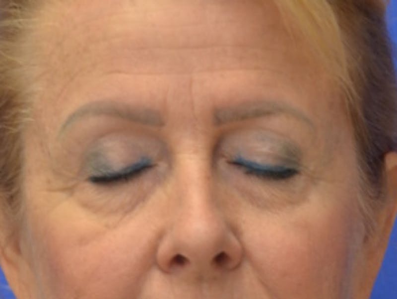 Blepharoplasty Before & After Gallery - Patient 182159 - Image 11