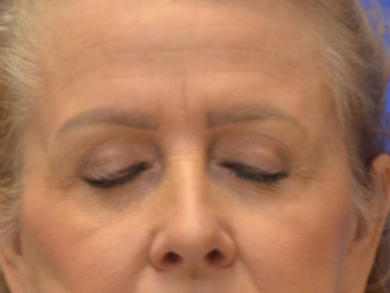 Blepharoplasty Before & After Gallery - Patient 182159 - Image 12