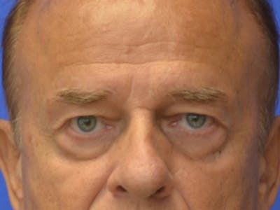 Blepharoplasty Before & After Gallery - Patient 210950 - Image 1