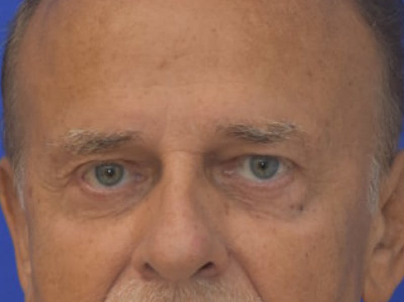 Blepharoplasty Before & After Gallery - Patient 210950 - Image 2