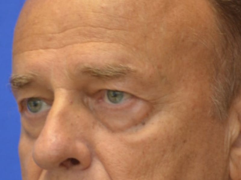 Blepharoplasty Before & After Gallery - Patient 210950 - Image 3