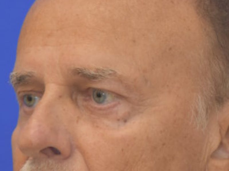 Blepharoplasty Before & After Gallery - Patient 210950 - Image 4