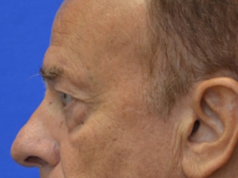 Blepharoplasty Before & After Gallery - Patient 210950 - Image 5