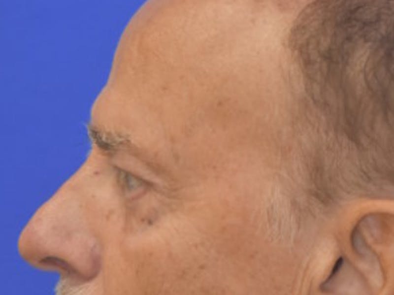 Blepharoplasty Before & After Gallery - Patient 210950 - Image 6