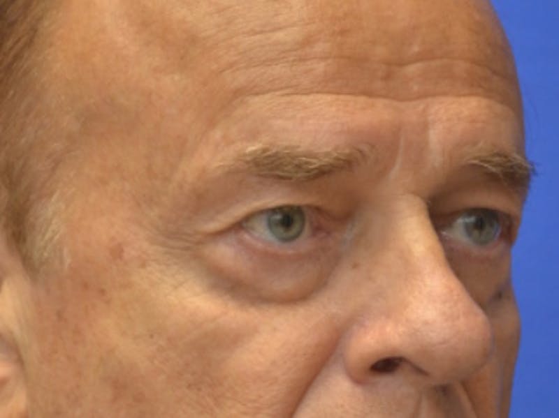 Blepharoplasty Before & After Gallery - Patient 210950 - Image 7