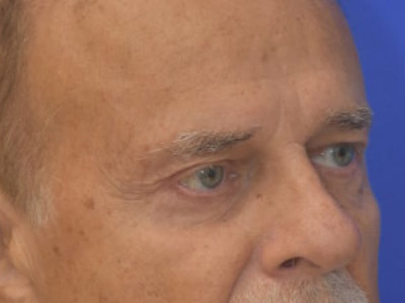 Blepharoplasty Before & After Gallery - Patient 210950 - Image 8