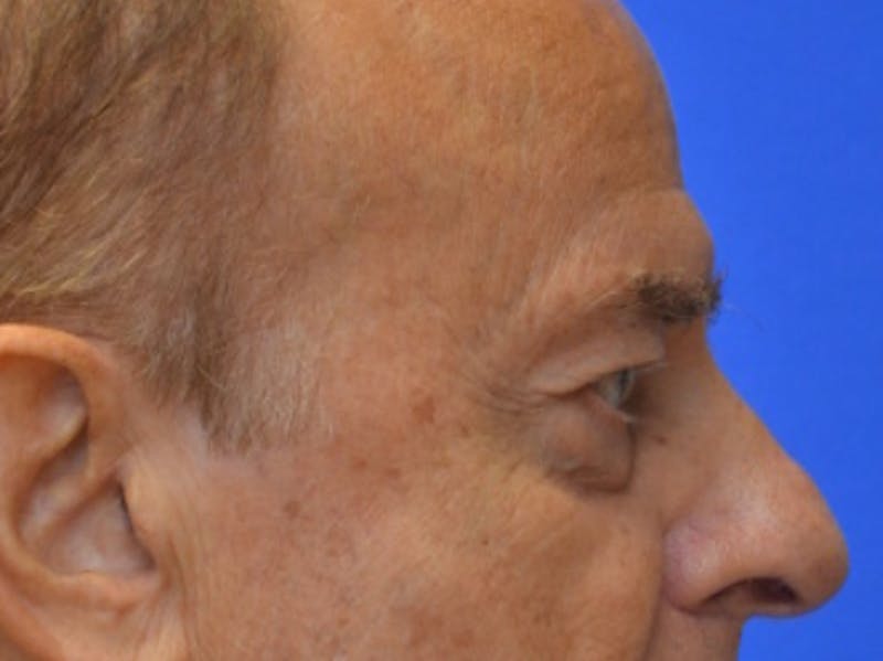 Blepharoplasty Before & After Gallery - Patient 210950 - Image 9