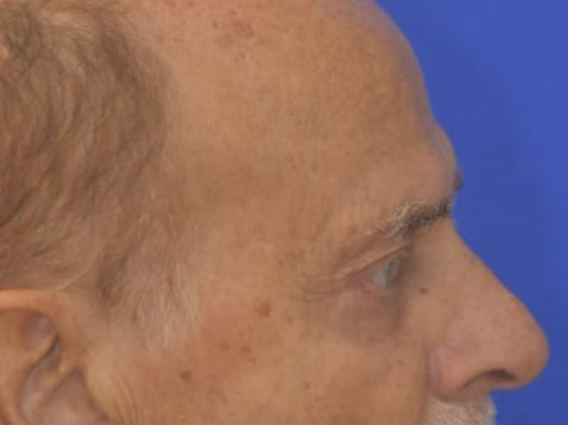 Blepharoplasty Before & After Gallery - Patient 210950 - Image 10