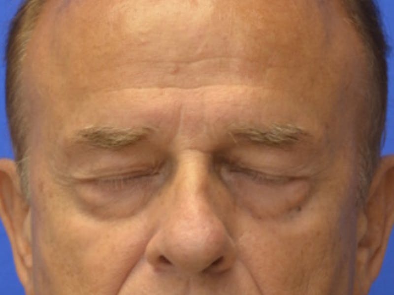 Blepharoplasty Before & After Gallery - Patient 210950 - Image 11