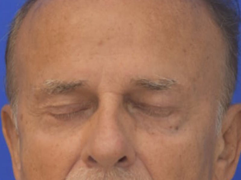 Blepharoplasty Before & After Gallery - Patient 210950 - Image 12