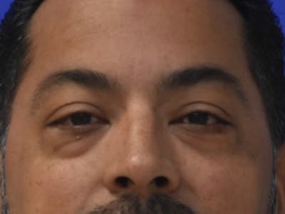 Blepharoplasty Before & After Gallery - Patient 340548 - Image 1