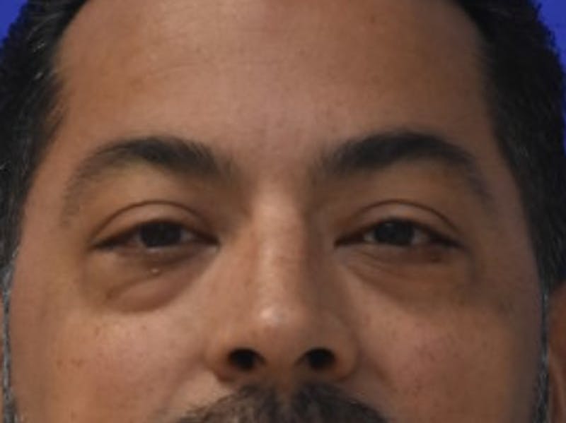 Blepharoplasty Before & After Gallery - Patient 340548 - Image 1
