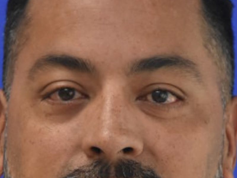 Blepharoplasty Before & After Gallery - Patient 340548 - Image 2