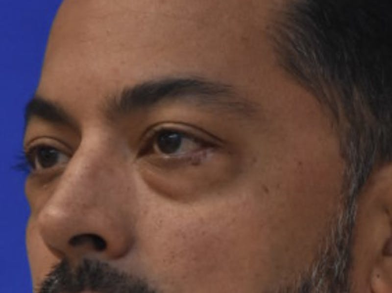 Blepharoplasty Before & After Gallery - Patient 340548 - Image 3