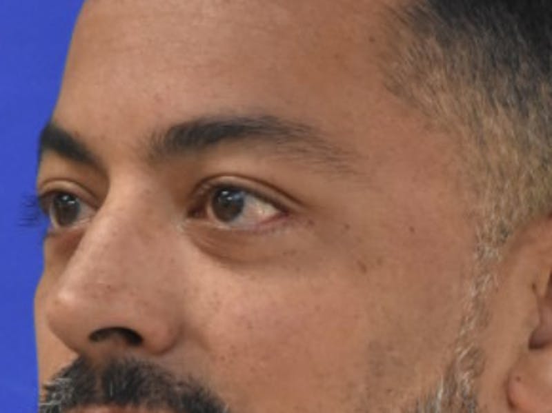 Blepharoplasty Before & After Gallery - Patient 340548 - Image 4