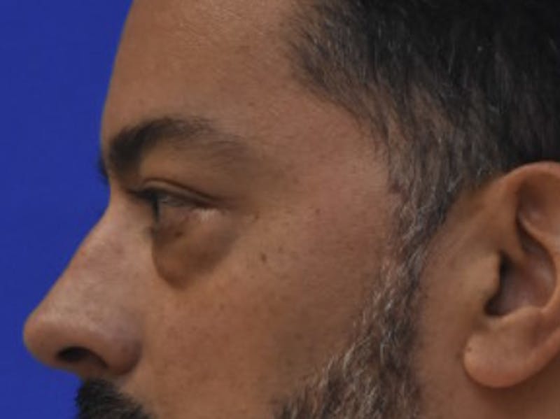Blepharoplasty Before & After Gallery - Patient 340548 - Image 5