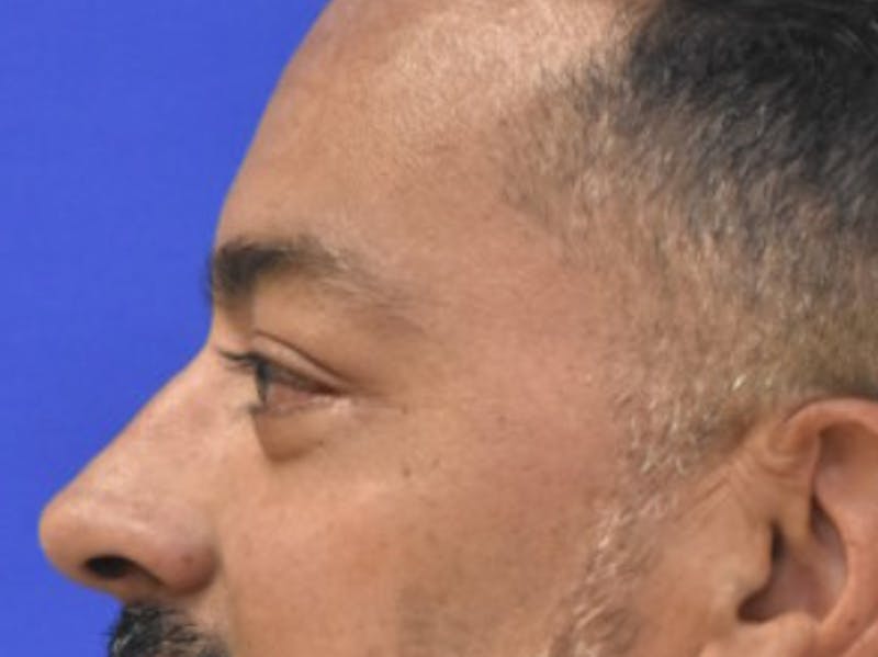 Blepharoplasty Before & After Gallery - Patient 340548 - Image 6
